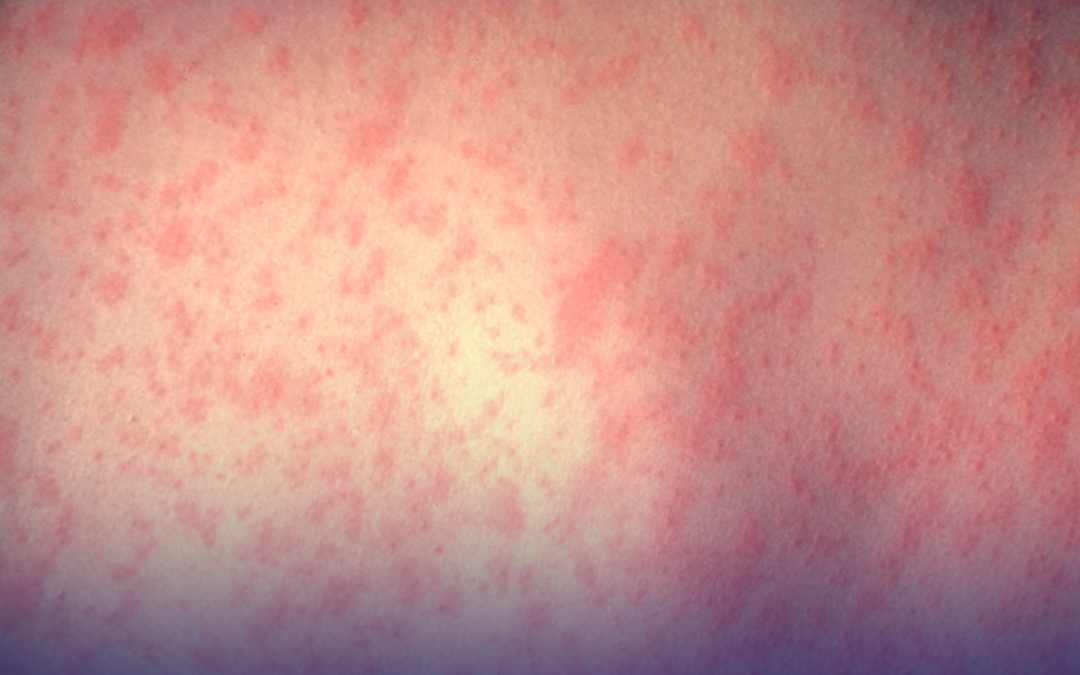 Detectan posibles exposición al sarampión en tres condados de Nuevo México