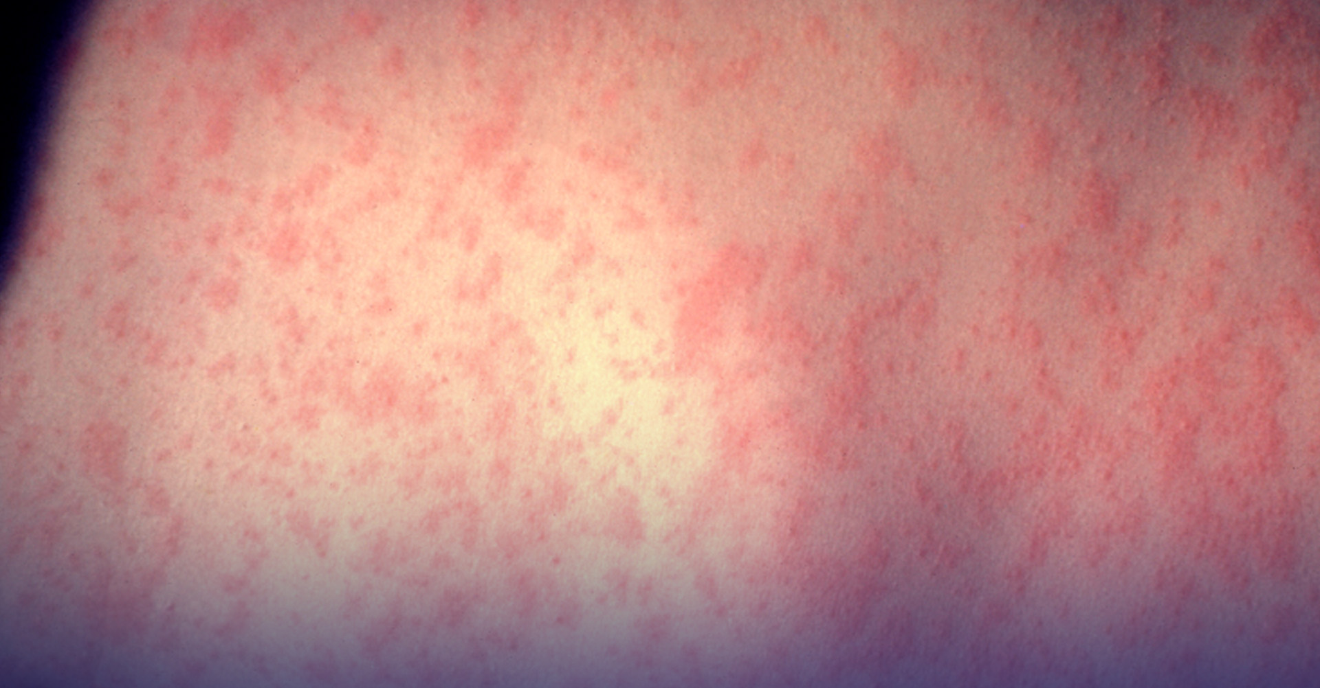 sarampión cruces gen